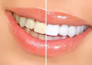 Dental Procedures Ontario Teeth Whitening